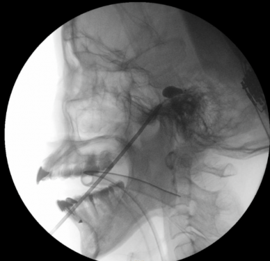 「經皮球囊壓迫術」屬微創介入技術，經面頰穿刺將球囊導管置入顱底的三叉神經節，並透過擴張球囊壓迫痛覺神經纖維，精準地阻斷痛覺傳導以緩解疼痛。